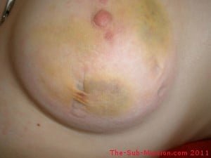 Tit Bruise, Fading